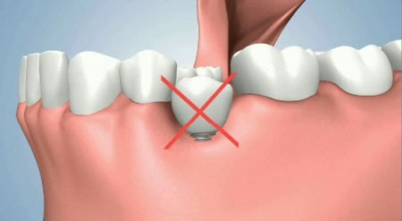 implant dentar Bucuresti, implantologie Bucuresti, clinica stomatologica Bucuresti