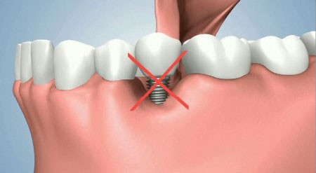 implant dentar Bucuresti, implantologie Bucuresti, clinica stomatologica Dr. Leustean