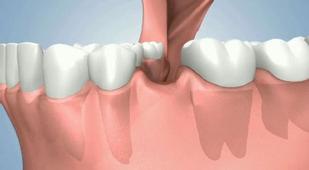 implant dentar Bucuresti, implantologie Bucuresti, clinica stomatologica Dr. Leustean