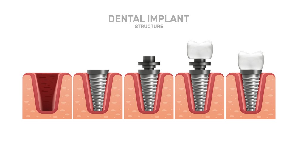 implant dentar Bucuresti, clinica stomatologica Dr. Leustean, stomatologie Bucuresti